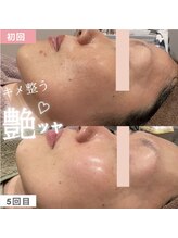 ハリーネ(HARINE)/【効果実感】