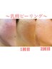 【ニキビ/毛穴でお悩みの方へ】ニキビケア＆艶肌☆乳酸ピーリング定価14300