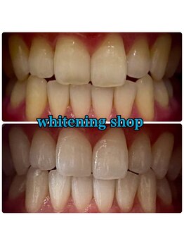 ホワイトニングショップ 大阪玉造店/Before&After美白ホワイトニング