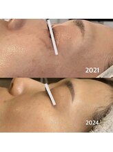 アリア(allia)/シミケア