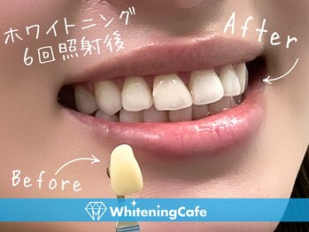 ホワイトニングカフェ 豊橋店/◎歯のホワイトニング施術写真◎