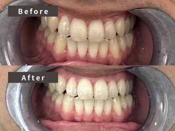 ピーチ(Peach)/セルフホワイトニング