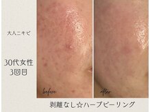 アールエスト(R EST.)/ニキビや跡にハーブピーリング！