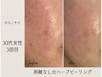 アールエスト(R EST.)/ニキビや跡にハーブピーリング!