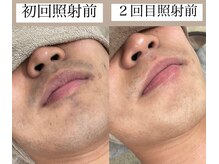 テンパ ビューティー(+10%beauty)/効果写真