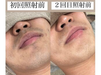 テンパ ビューティー(+10%beauty)/効果写真