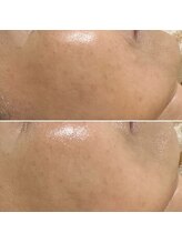 ハーナウ ハウ(hanau hou)/ハーブピーリング効果