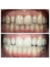 ボゴス(BOGOSS)/【歯のセルフホワイトニング】