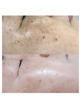 エクラ(eclat)/ACトリートメント