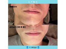 アーヒル(A”-HILU)の雰囲気（県内最安値脱毛！更なるコスパを求める方は【セルフ脱毛】も◎）