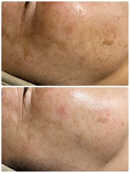 ルーメ(lume)/シミケア40代女性