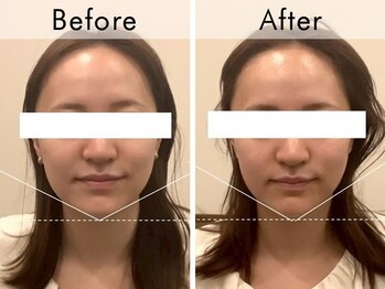 ハリラウンジ 恵比寿本店(Hari Lounge)/美容鍼専門サロン Hari Lounge