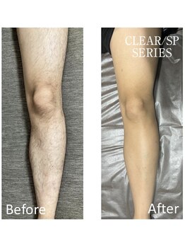 アットイカウ 下北沢(at ikaw)/下半身脱毛 Before/After