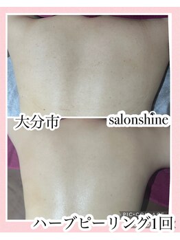 サロンシャイン(Salon Shine)/背中ハード1回