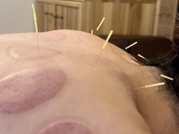 たから鍼灸院の写真/たるみ改善、小顔ケアはもちろん、肩こりや背中の張りなどのお悩みも改善◎深層筋に鍼で直接アプローチ◎