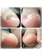 ココペリ(Nail Salon＆School kokopelli)の写真/巻爪ケアと角質ケアで足元を整え、パック付きフットマッサージで至福の時を☆