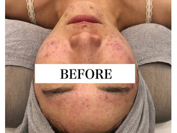 プシュケ(PSYCHE)/ニキビケア＊BEFORE