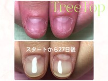 ツリートップ(Tree Top)/深爪矯正