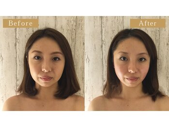 モモスパ(MOMOspa.)/頭蓋骨小顔矯正ビフォアフター