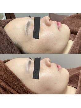 エステティックレイビス 名古屋店(RAYVIS)/ハーブピーリングでシミケア!