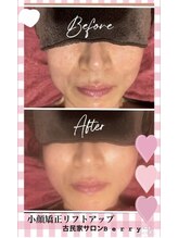 ベリー(Berry)/小顔矯正リフトアップ