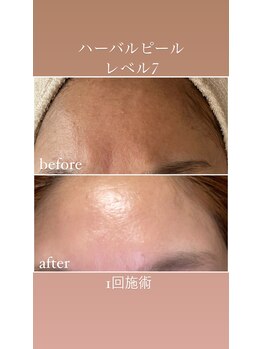 リュミエール(LUMIERE)/ハーバルピールレベル7