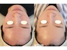 その方の肌に合った施術を○受けるほど素肌に自信が持てるように