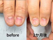 ナチュリア(Natulea)/深爪自爪育成2か月の変化
