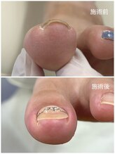 レフス 北参道店(REFUSS)/巻き爪矯正