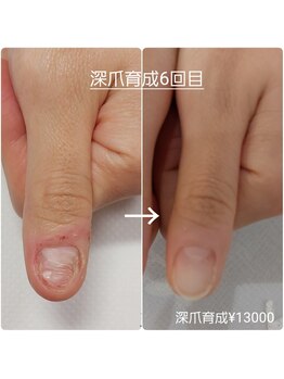 ピピ(PiPi)/【深爪育成】