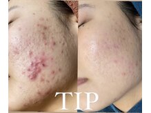 ノヴェイル(NoVeil)