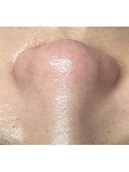 毛穴ケアをしたい