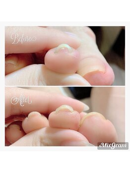 巻いてる爪へのダメージ軽減！