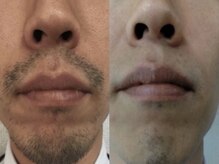 ヴィオール 名古屋栄店(VIOR)/【メンズ脱毛】　ひげ