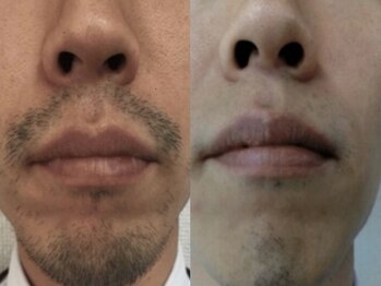 ヴィオール 名古屋栄店(VIOR)/【メンズ脱毛】 ひげ