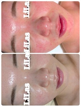 リラ(LiLas)の写真/最新の皮膚理論とリアボーテ幹細胞導入で、原因から一緒に向き合うケア◎