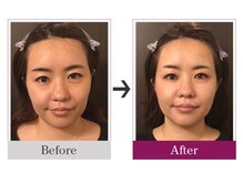 ビコツゼロ 心斎橋(BIKOTSU ZERO)/小顔・目の高さ違い