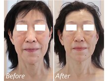 ドクターボディ 新宿店(Dr.Body)/【たるみ/顎関節　60代】10回