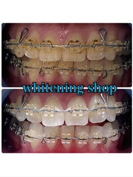 ホワイトニングショップ 京都駅前店/40分×2回Before/After