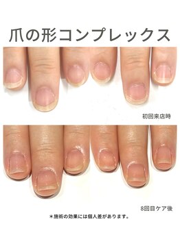 40代/甘皮多/3ヶ月後アフター