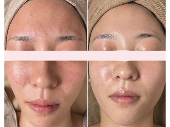 エイプリルフールズ(April fools)/【20代】毛穴皮脂詰まりスッキリ