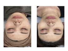 エミリー 守山(EMILY)/【症例写真】ハーブピーリング1