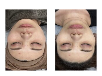 エミリー 守山(EMILY)/【症例写真】ハーブピーリング1