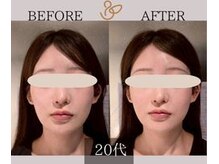チョコバリ 新宿店(chocobari)/小顔×リフトアップ(美容鍼)20代