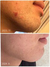 ククル(KUKULU)/Men’s 脱毛 10回目 (20代男性)