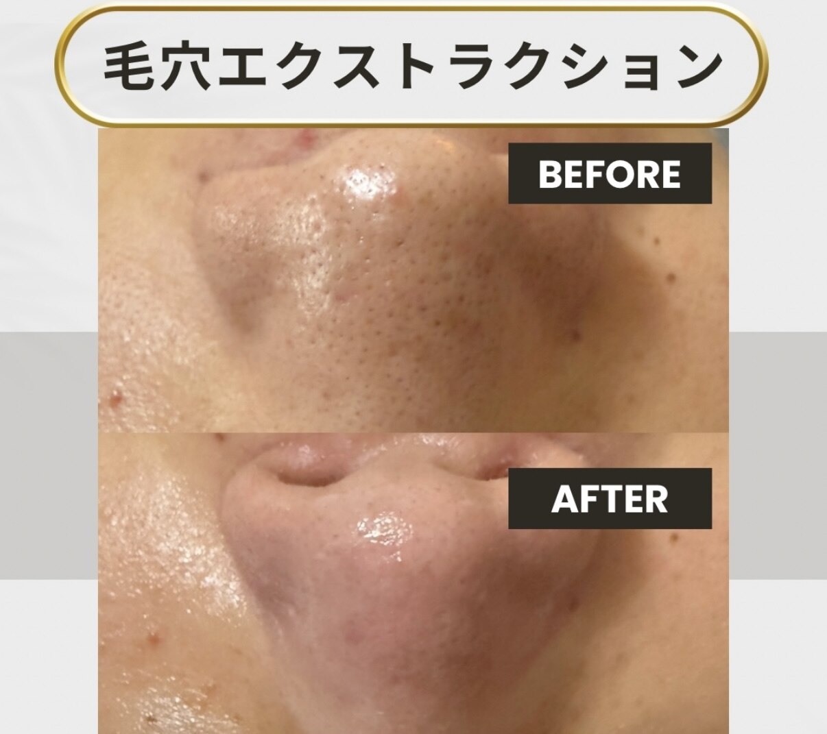 山口県で毛穴ケアが人気のエステサロン｜ホットペッパービューティー