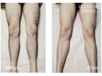 アットイカウ 下北沢(at ikaw)/下半身脱毛 Before/After