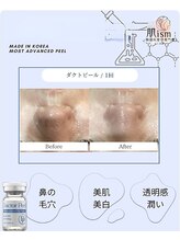 肌イズム 守谷店(肌ism)/【before&after】ダクトピール
