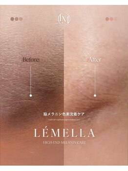 【 韓国式メラニンケア専門店 - onyu - 】 ルメラ/黒ずみケア/フェイシャル/