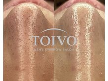トイヴォ(TOIVO)/毛穴洗浄ビフォーアフター！
